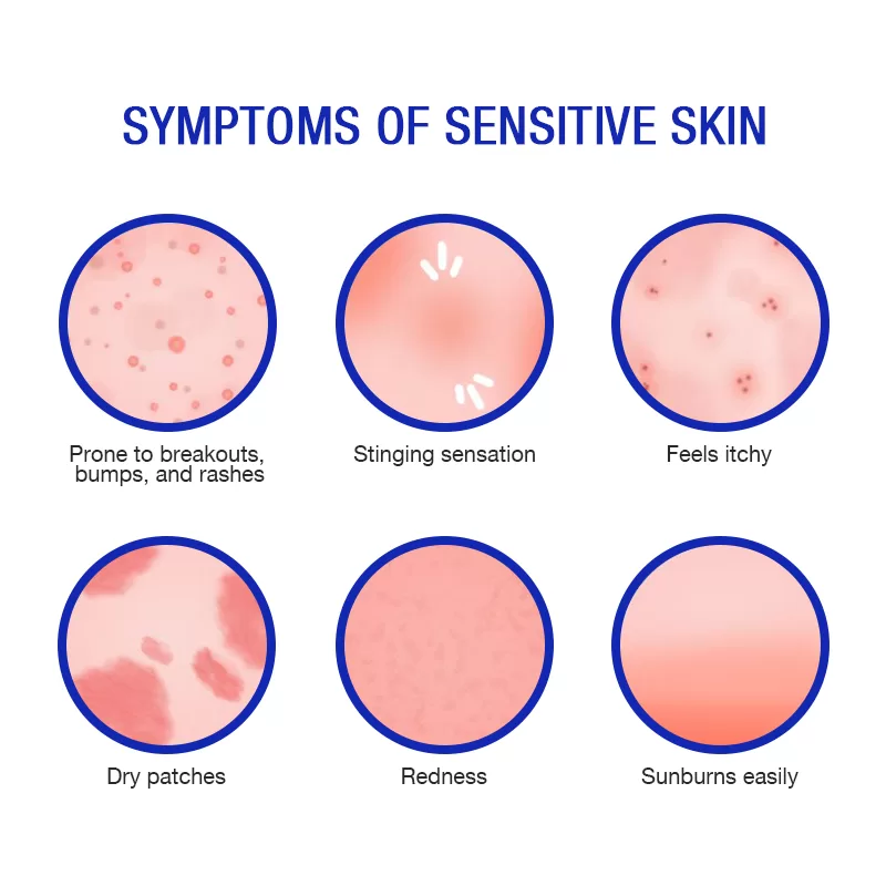 sensitive skin symptoms