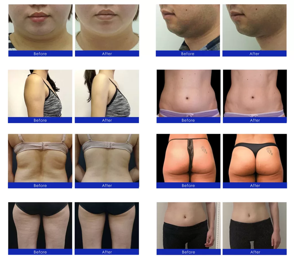 before & after of CoolSlimming vs. UMS Sculptor treatment