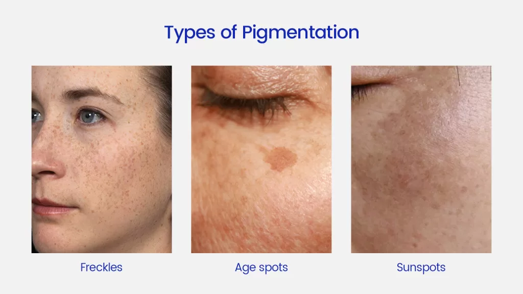 three types of pigmentation on face