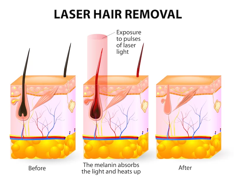 Laser hair removal working principle figure