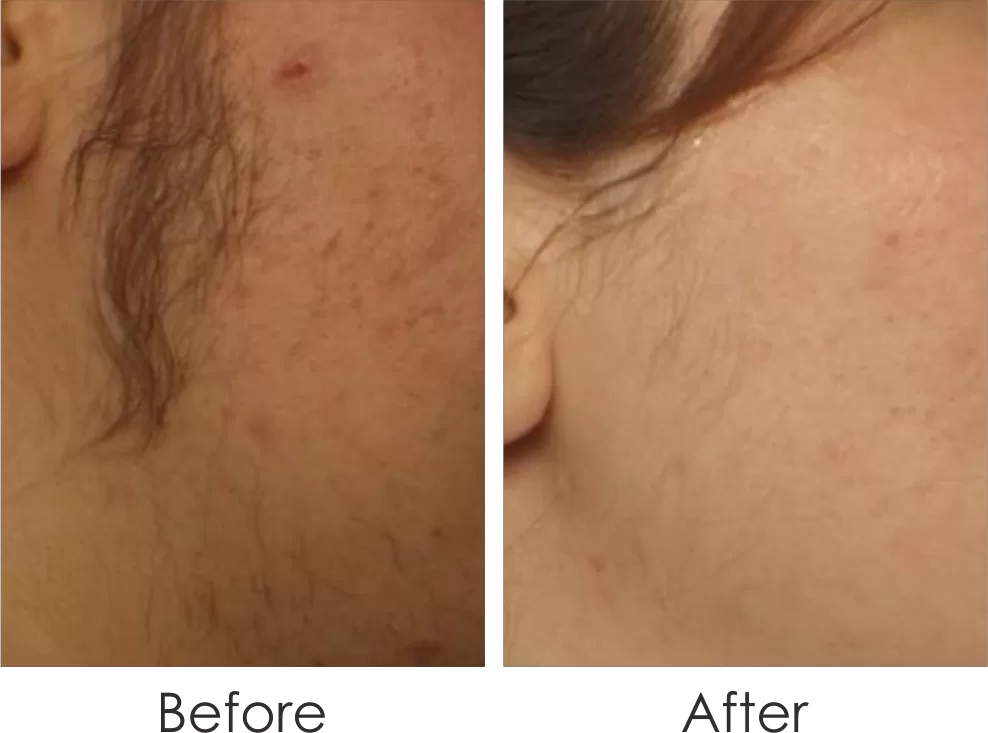 before & after of laser treatment for hair on the temples
