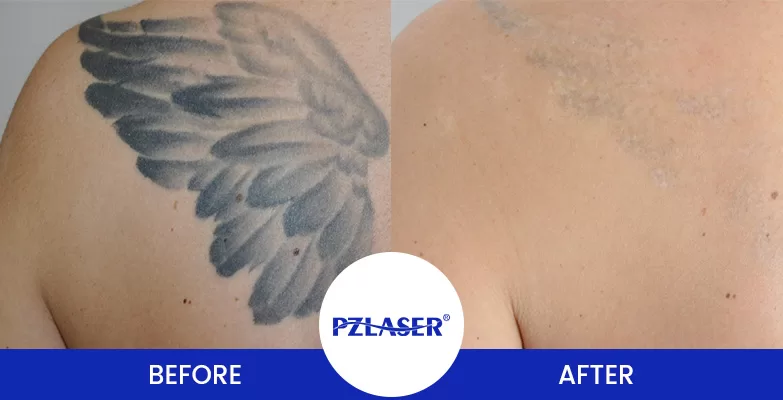 PicoIris® picosecond laser machine laser tattoo removal before and after
