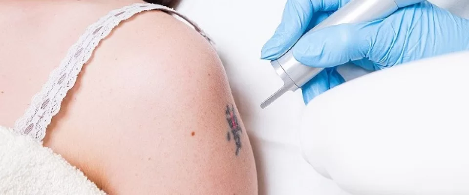 Removing tattoo on arm of a young woman by medical picosecond laser machine