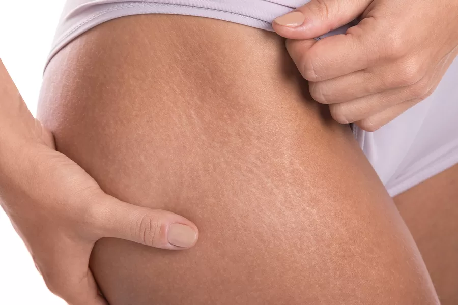 The Stretch Marks On a Woman's Leg