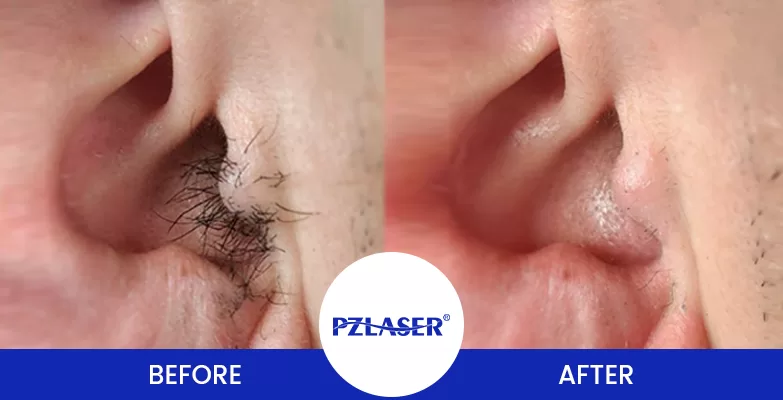 ear electrolysis laser hair removal before and after
