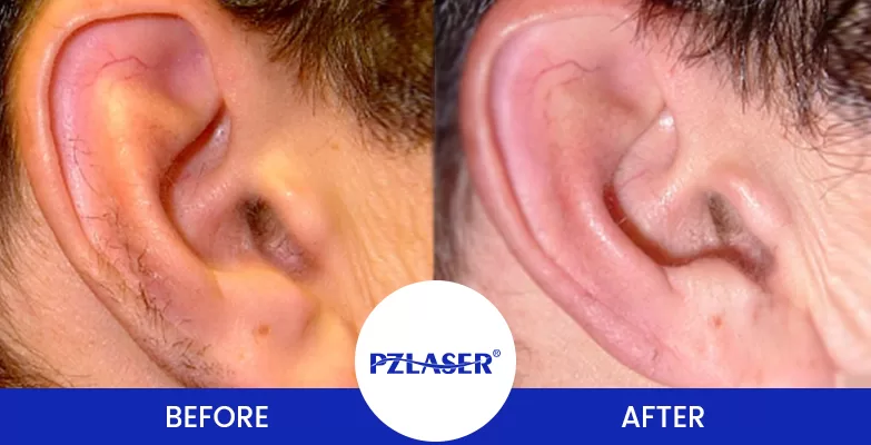 ear laser hair removal before and after