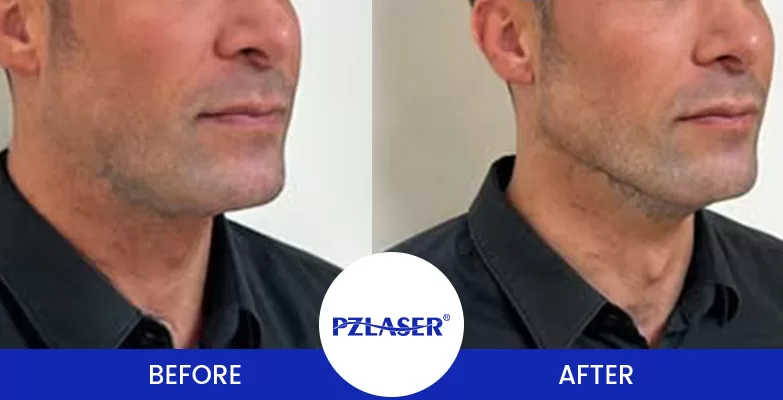 1 HIFU Sessions for Jawline Before & After Photo