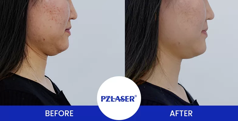 3 HIFU Sessions for Jawline Before & After Photo