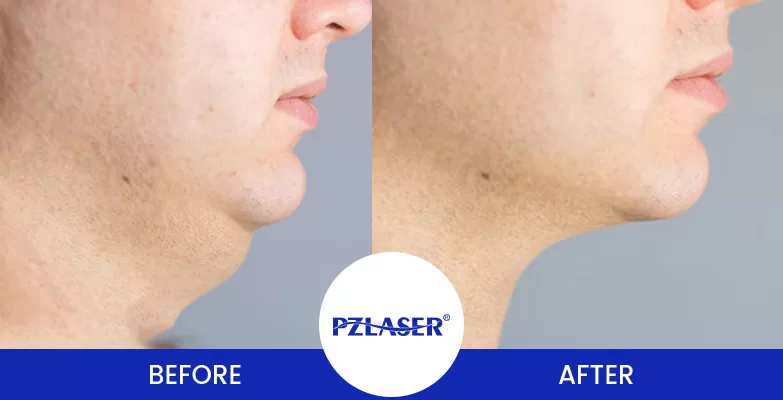5 HIFU Sessions for Jawline Before & After Photo