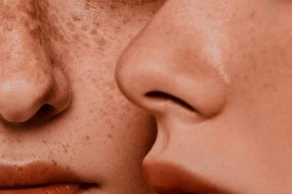 Stubborn hyperpigmentation skin problems on face