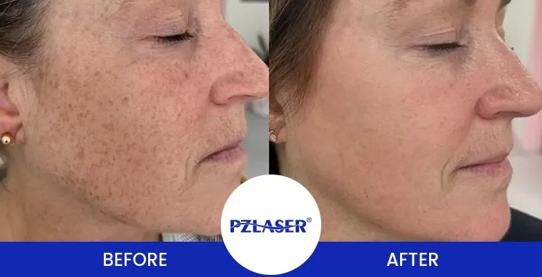 Pico laser for treating hyperpigmentation on the famale's face before and after