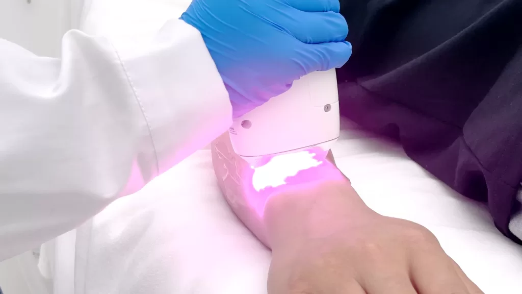 apply the laser on the arm