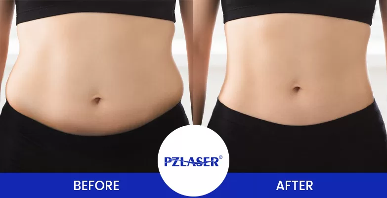 before and after of laser lipo treatment on abdomen