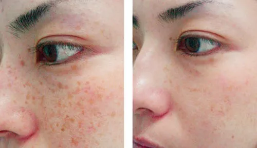 Pigmented lesion lasers treatment before and after