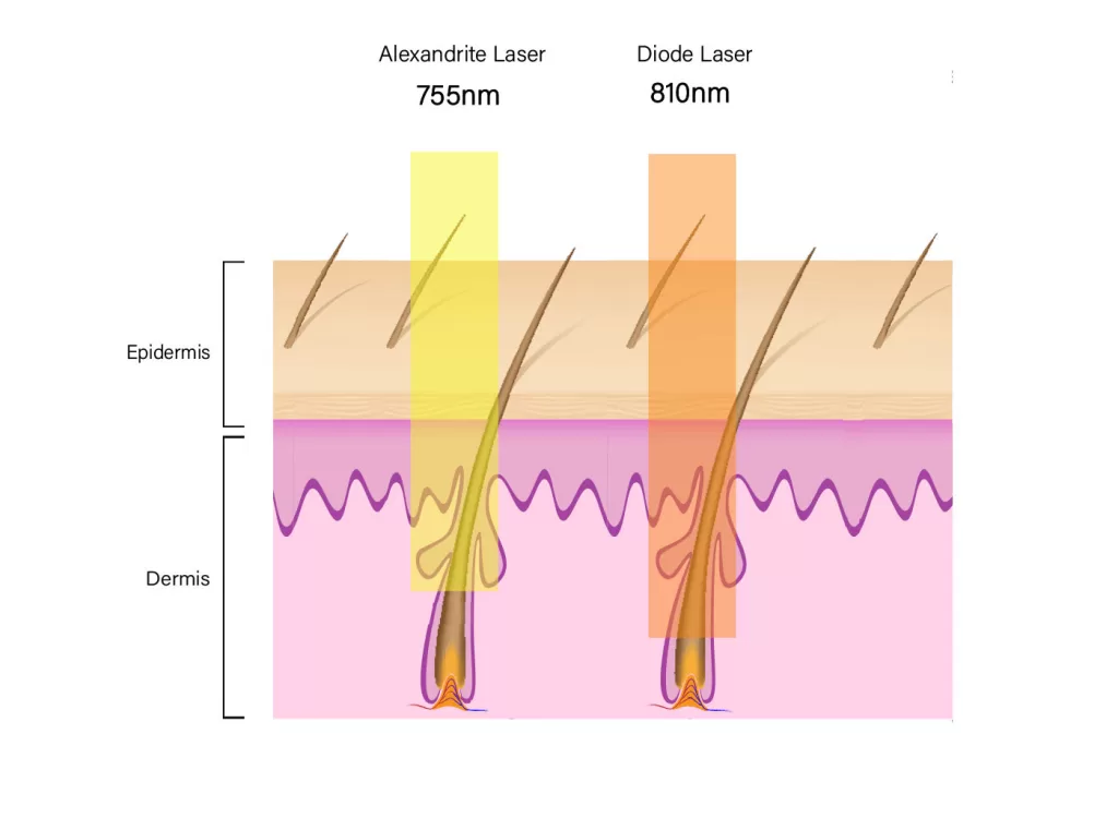 alexandrite laser vs diode laser penetration depth principle diagram
