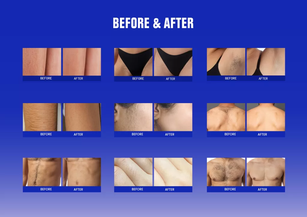 laser hair removal before and after for full body areas