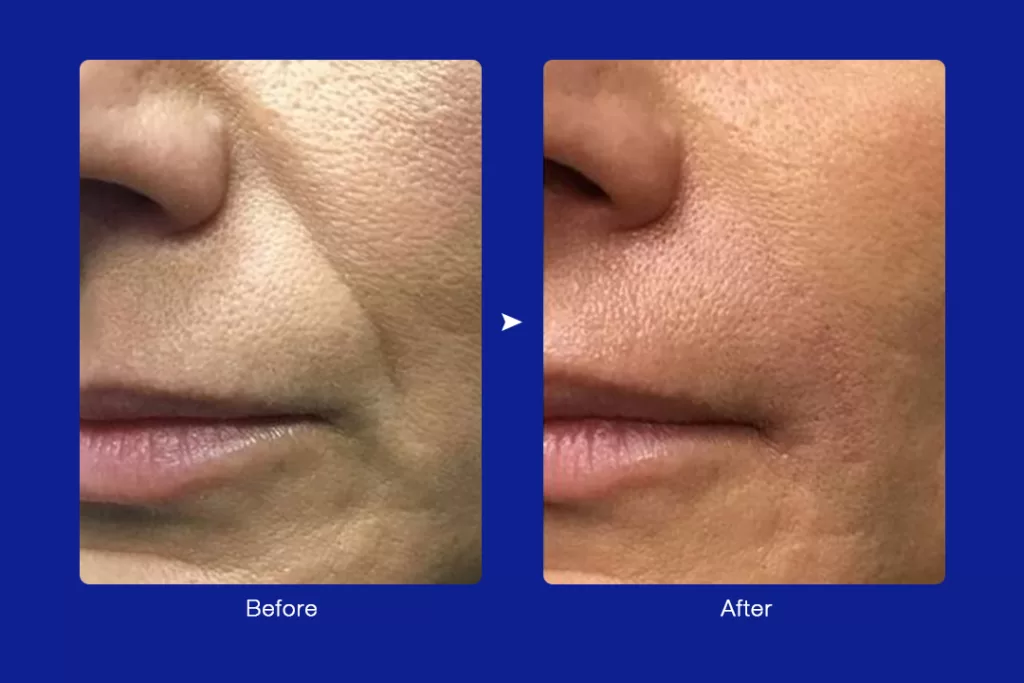 ultrasonic facial for pore reduction before and after
