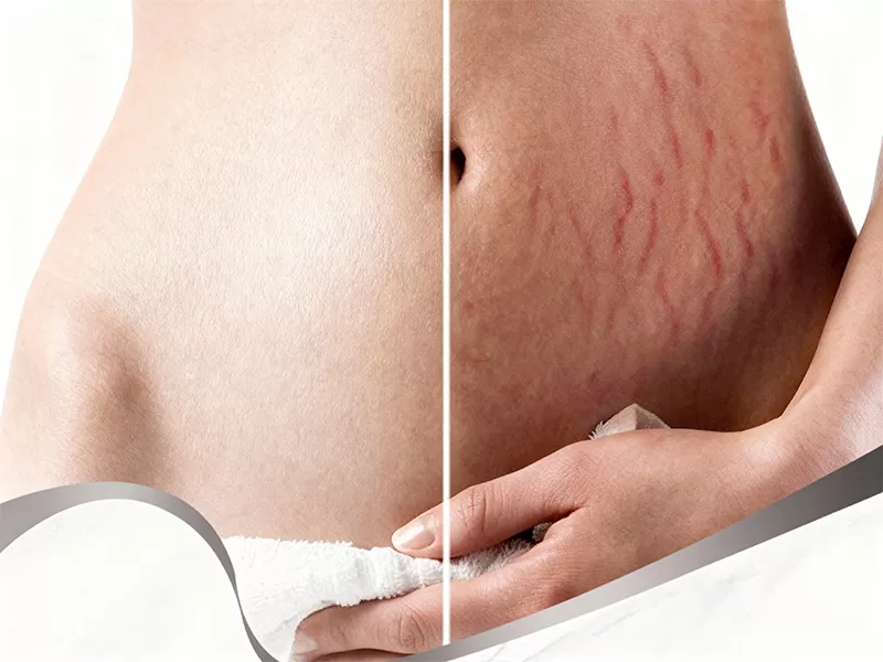 does glutathione remove stretch marks Top Laser Mark Removal Machines and Costs BPC-157 Peptide Capsule. Enhanced