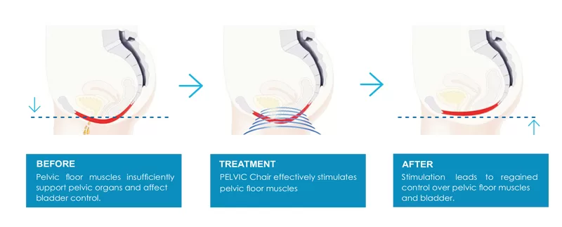 A pelvic floor machine is a therapeutic device (whether electromagnetic, electrical stimulation, biofeedback, or mechanical) designed to stimulate and train pelvic floor muscles.