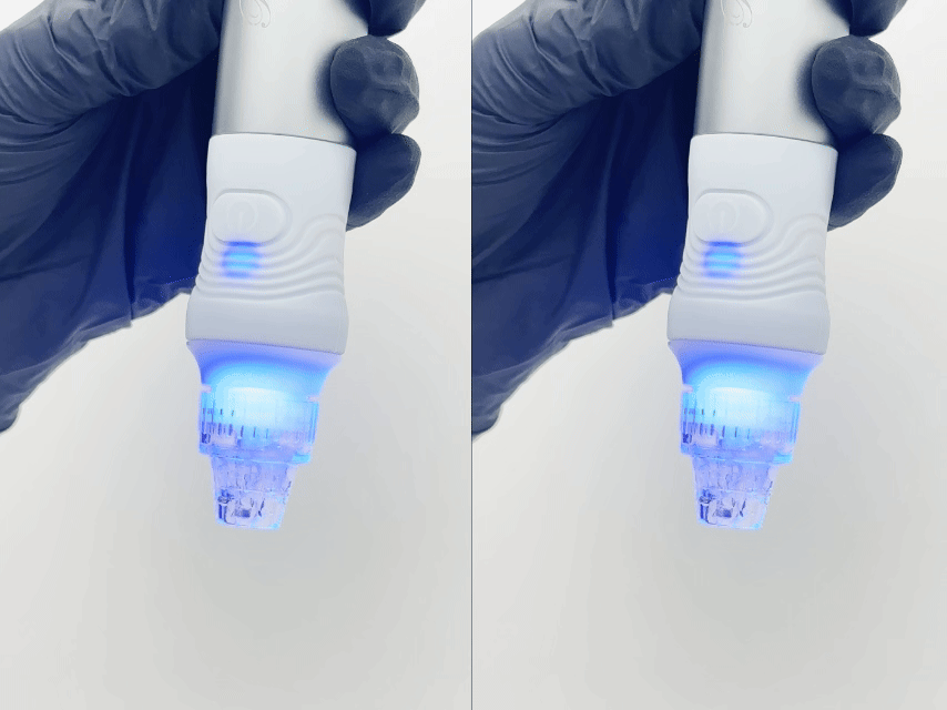 At the core of medical-grade hydrodermabrasion, vortex fusion technology uses a spiral tip design to simultaneously extract impurities and infuse active solutions