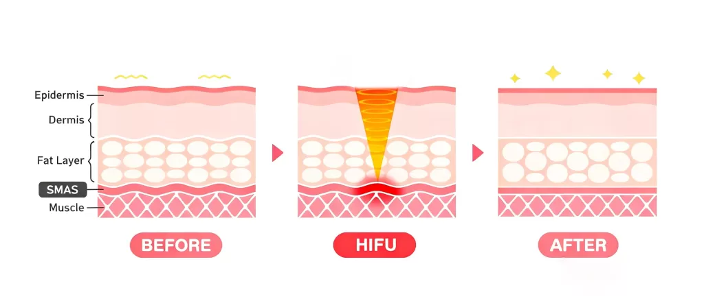 Ultrasound stands out from other energy-based technologies because it can target deeper than both lasers and radiofrequency, including the SMAS