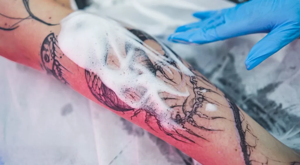 clinics increasingly need Multi-Color Tattoo Removal Laser platforms capable of handling a wide pigment spectrum.
