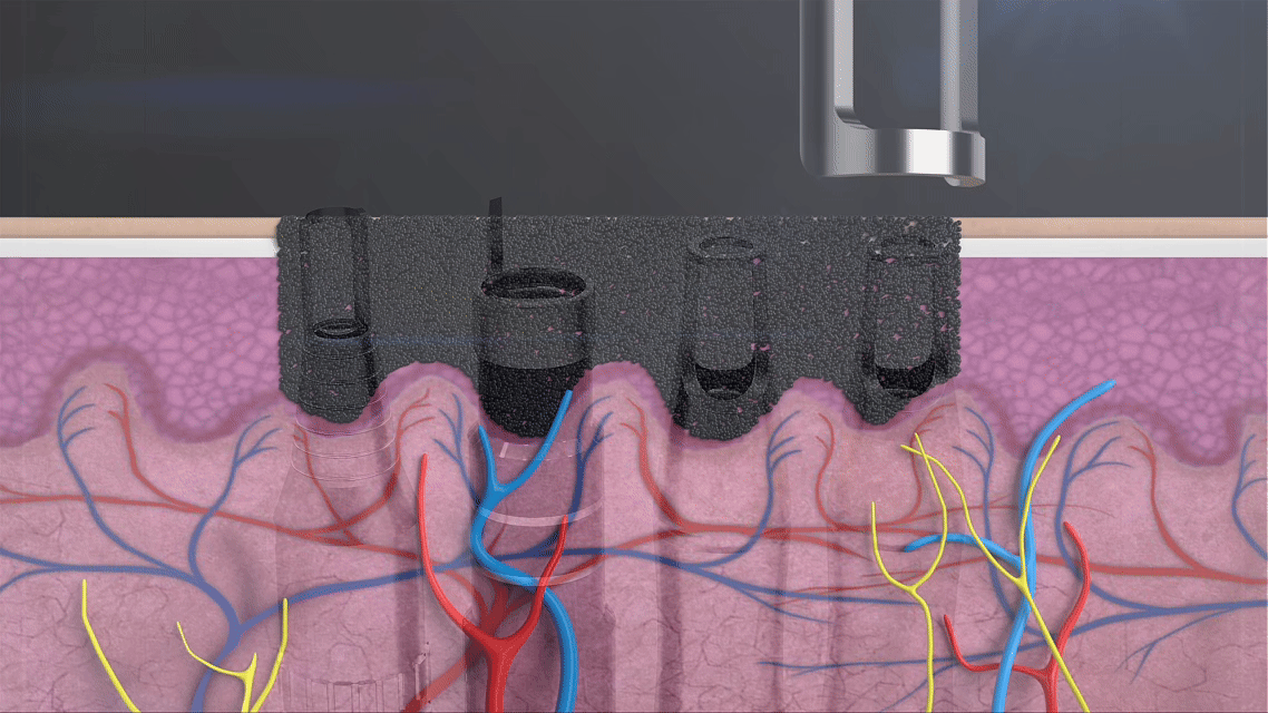 For most clinics, picosecond and thulium technologies currently offer the best balance between efficacy, safety, patient satisfaction, and return on investment.