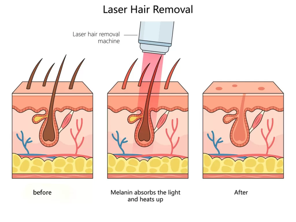 How Does a Diode Laser Hair Removal Machine Work?