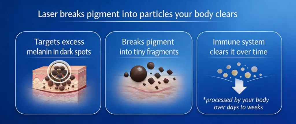 How Does a Laser for Pigmentation Removal Work