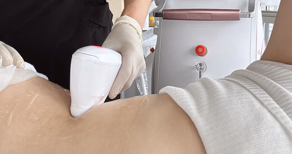 Not all HIFU treatments deliver the same outcomes. The effectiveness of collagen stimulation depends on several important factors.